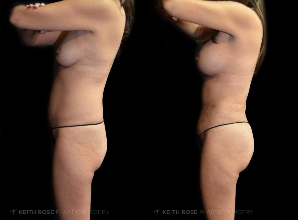 0001_rose_mommymakeover_corpuschristi_patient60b