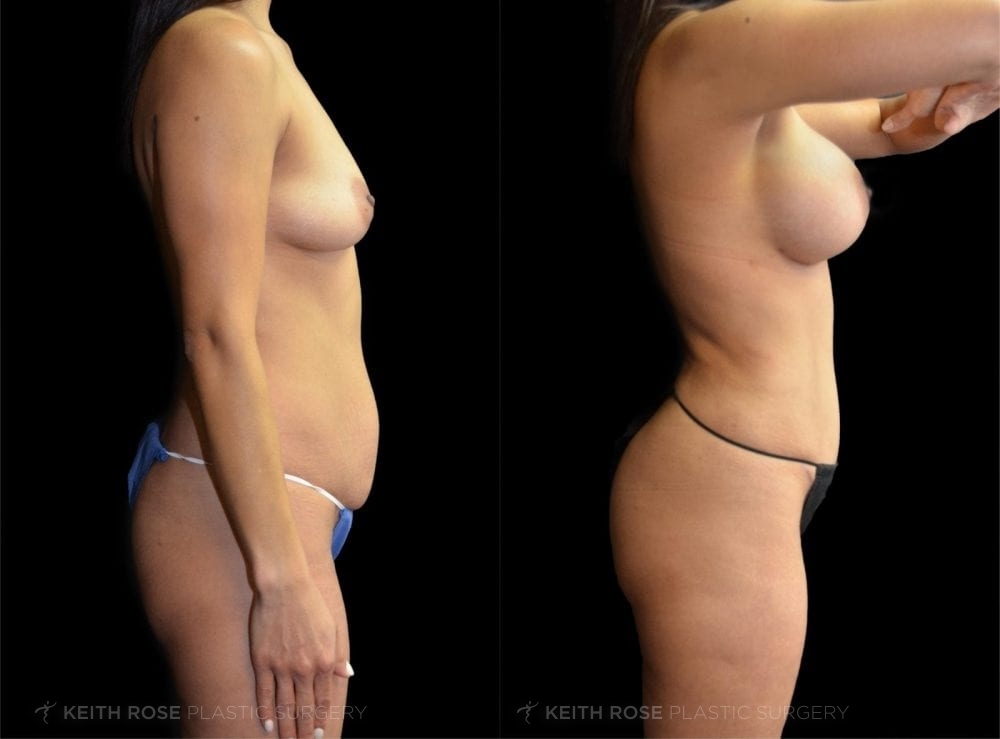 0003_rose_mommymakeover_corpuschristi_patient59a