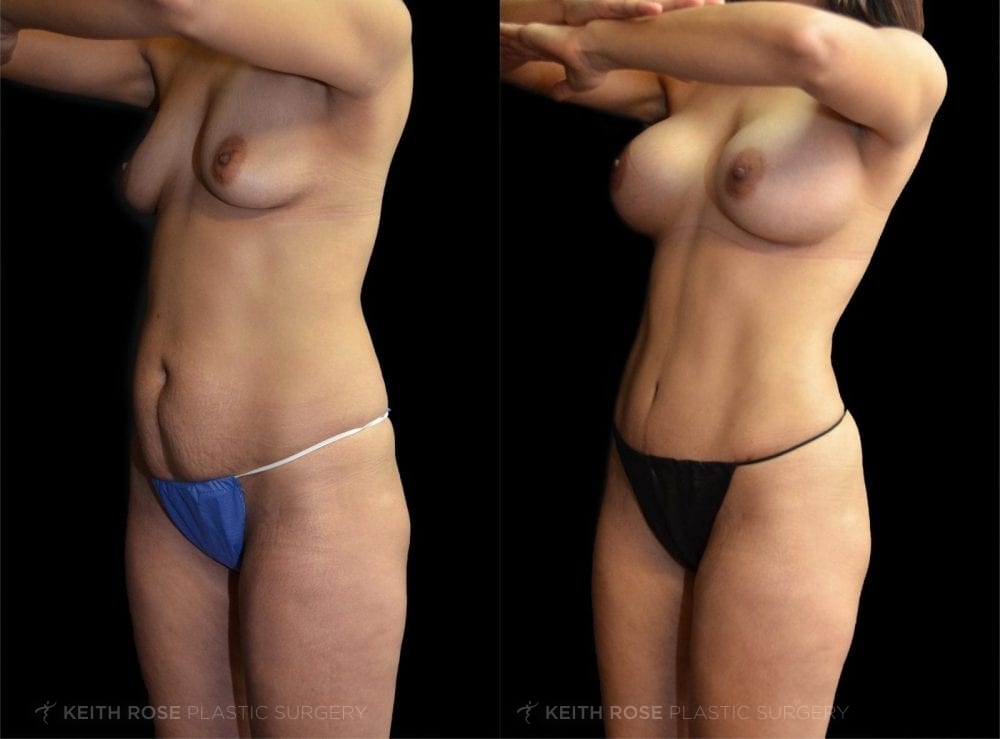 0005_rose_mommymakeover_corpuschristi_patient59c