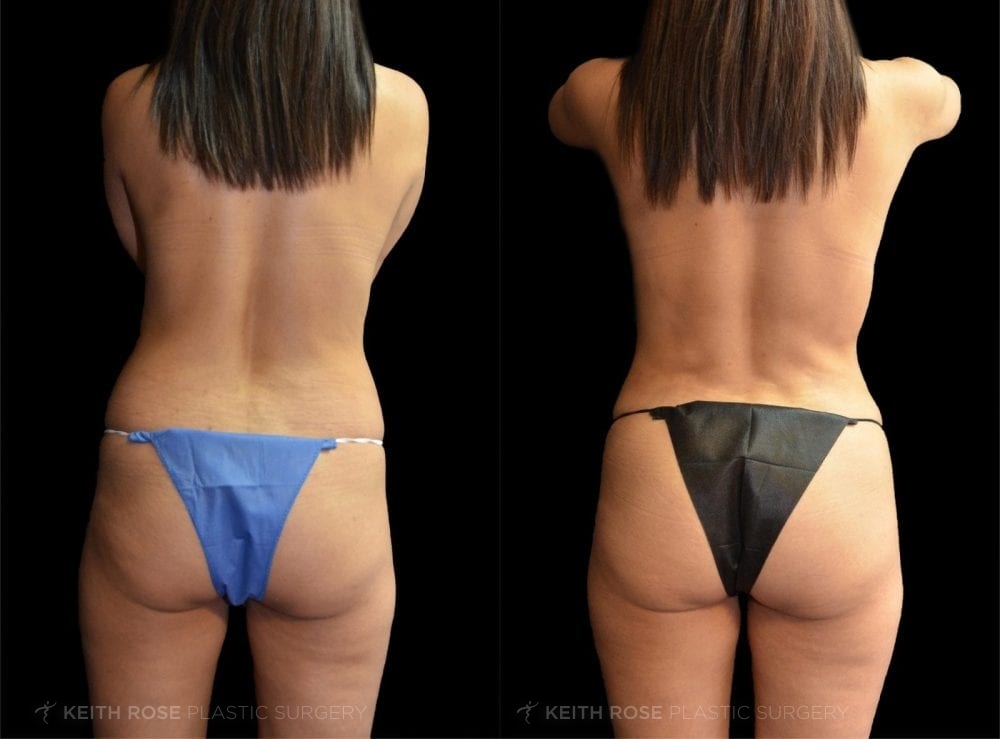 0006_rose_mommymakeover_corpuschristi_patient59d