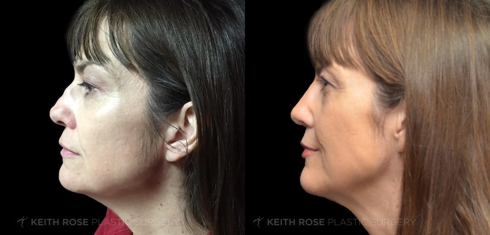 Rhinoplasty Patient 47: Before and After