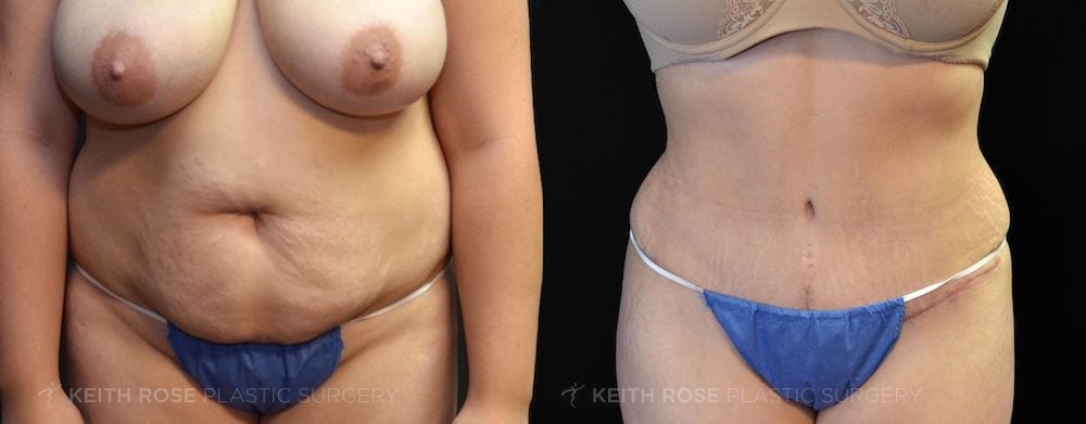 Patient 23 View 1 Tummy Tuck Before and After