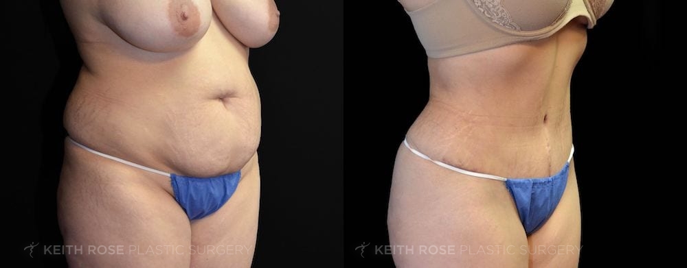 Patient 23 View 2 Tummy Tuck Before and After