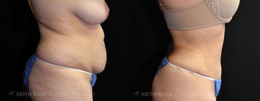 Patient 23 View 3 Tummy Tuck Before and After