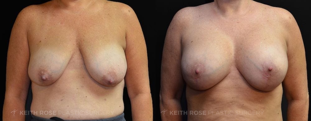 Patient 40 Breast Augmentation Before and After