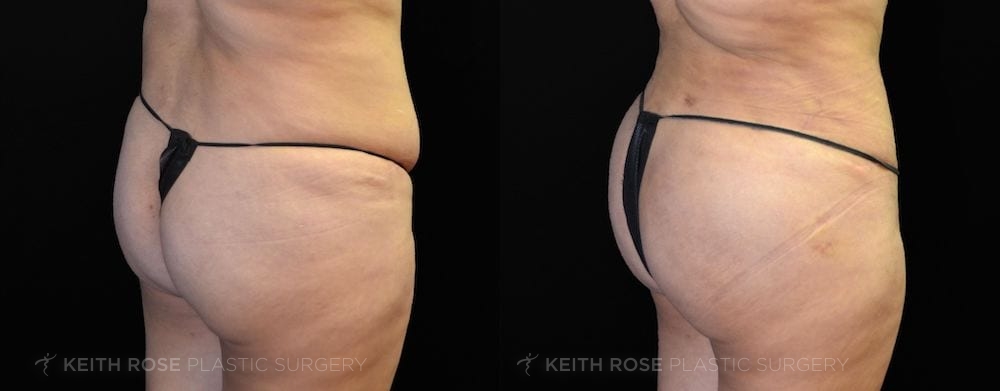 Patient 5 View 1 Liposuction and BBL Before and After