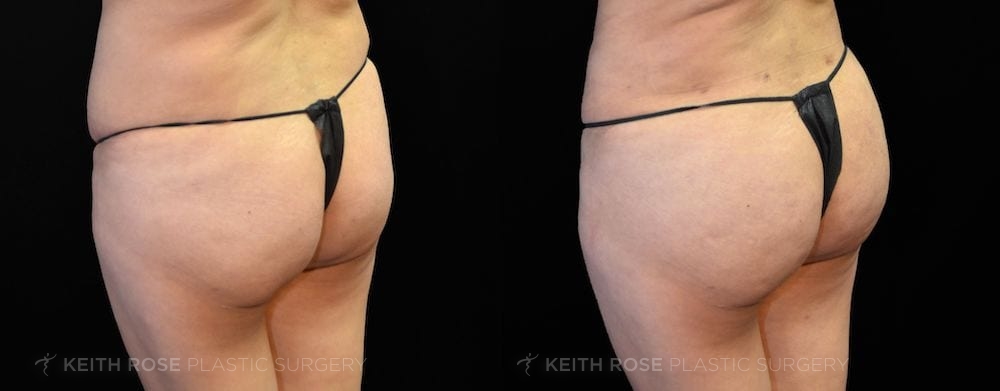 Patient 5 View 2 Liposuction and BBL Before and After