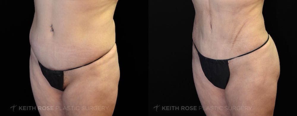 Patient 5 View 3 Liposuction and BBL Before and After
