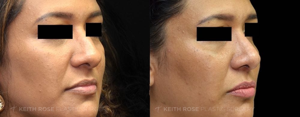 Patient 1 View 1 Rhinoplasty Before and After