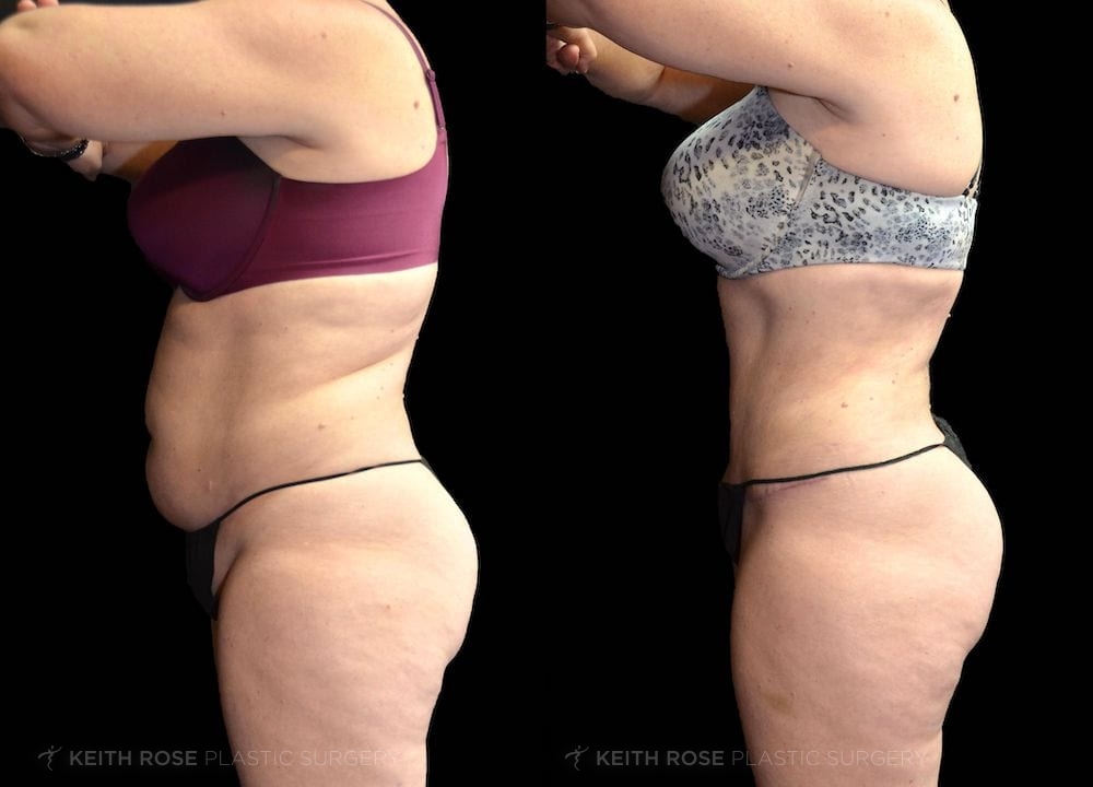 Patient 7 View 1 Tummy Tuck and Lipo Before and After