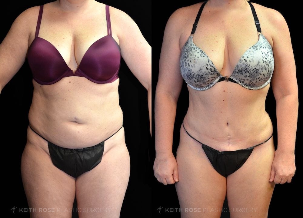 Patient 7 View 2 Tummy Tuck and Lipo Before and After