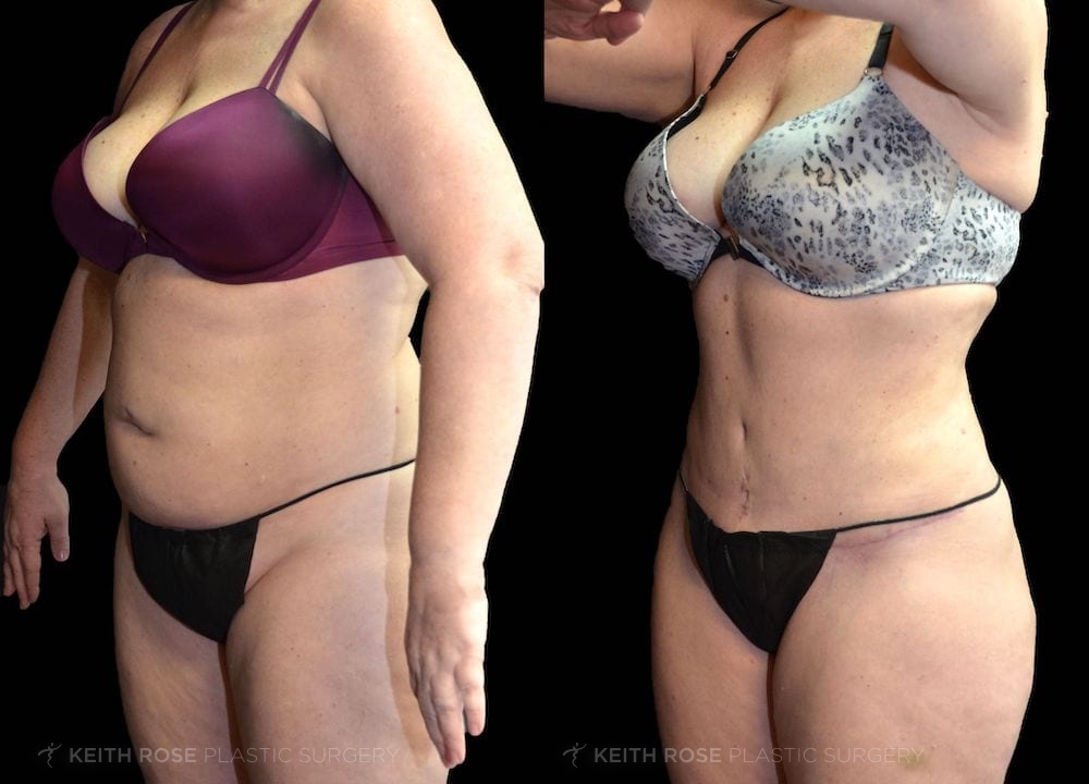 Patient 7 View 3 Tummy Tuck and Lipo Before and After