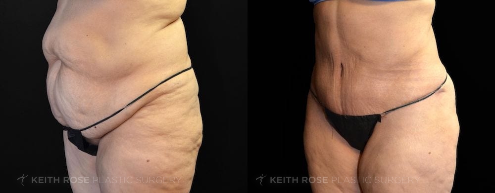 Patient 6 View 1 Tummy Tuck and Lipo Before and After