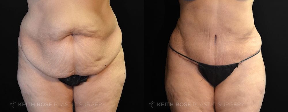 Patient 6 View 2 Tummy Tuck and Lipo Before and After