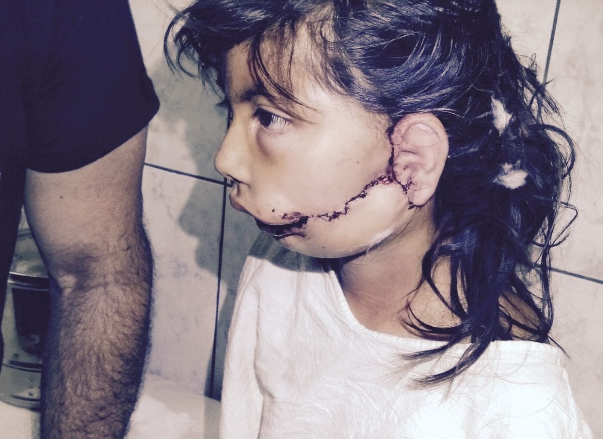 Child patient after face surgery 1
