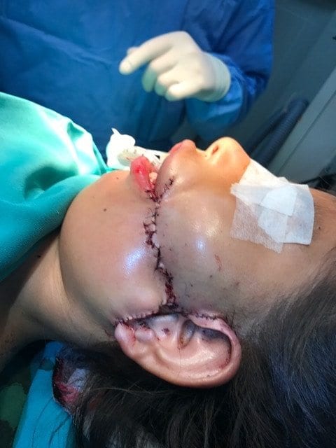 Child patient after facial surgery