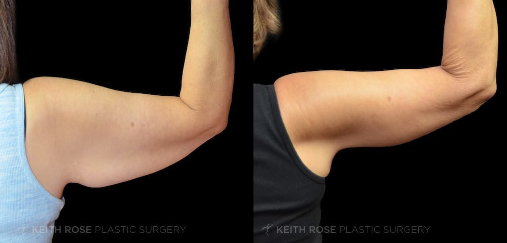 0001_rose_brachioplasty_corpuschristi_patient182720b