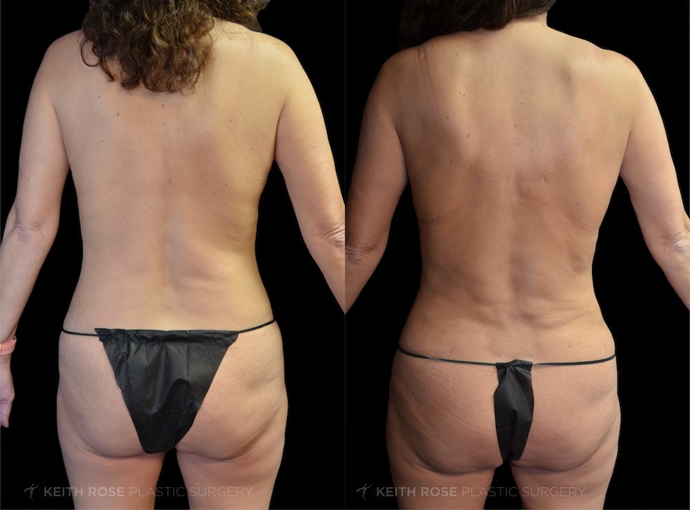 0000_rose_mommymakeover_corpuschristi_patient20200302a