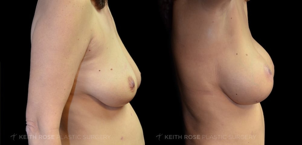 0001_rose_breastaugmentation_corpuschristi_patient20200302-1a