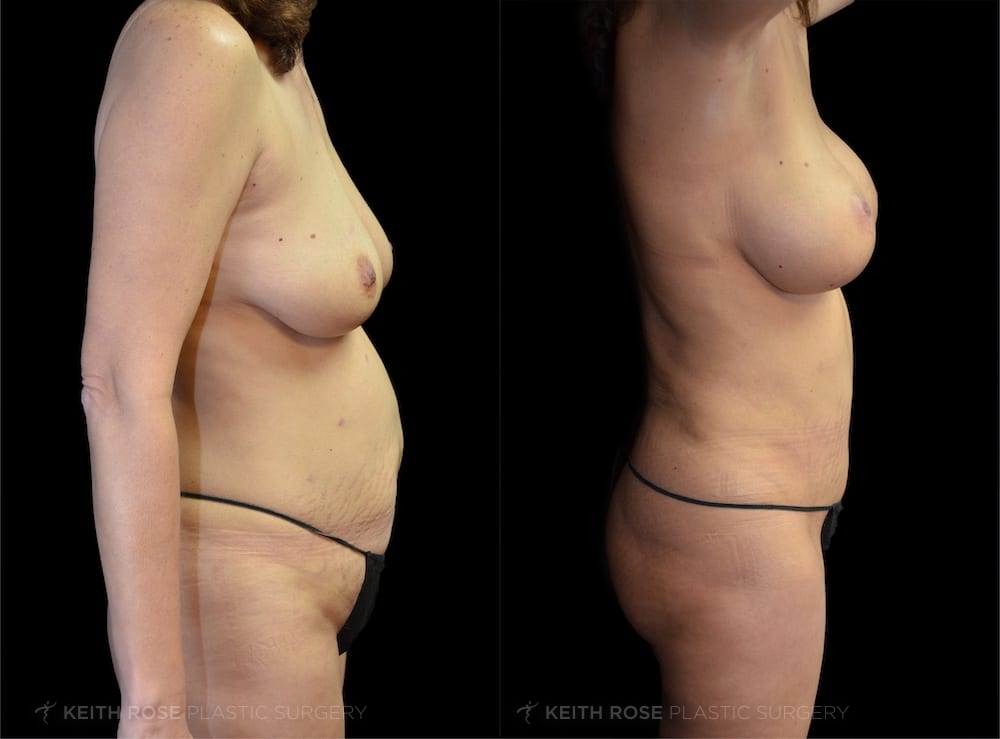 0002_rose_mommymakeover_corpuschristi_patient20200302c