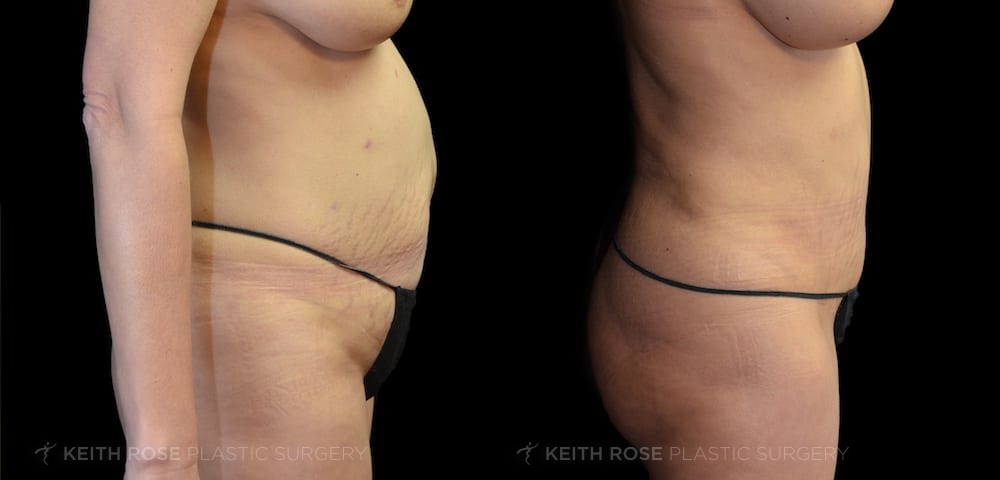0004_rose_tummytuck_corpuschristi_patient20200302-1b