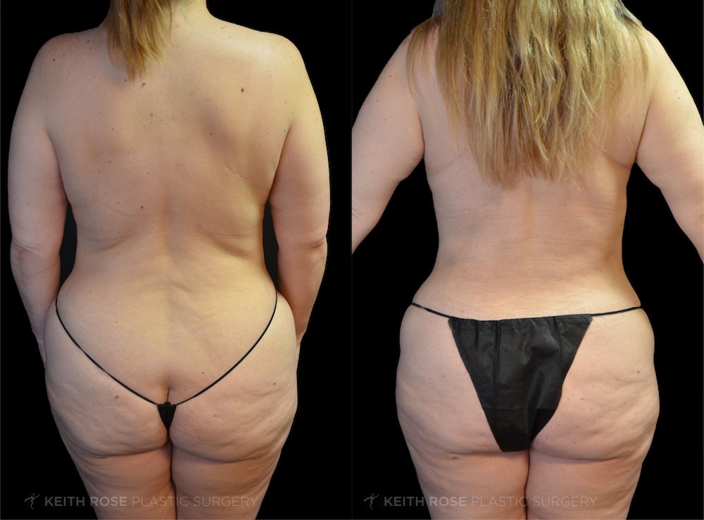 0000_rose_mommymakeover_corpuschristi_patient015a